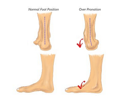 Diagram demonstrating neutral ankle position and over-pronated ankle position