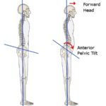 diagram demonstrating neutral correct posture and poor posture with anterior pelvic tilt